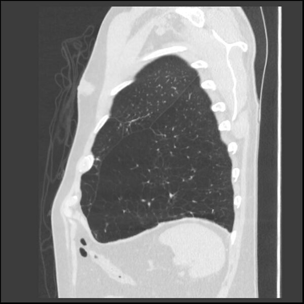 File:Alpha-1-antitrypsin deficiency (Radiopaedia 40993-43722 Sagittal lung window 41).jpg