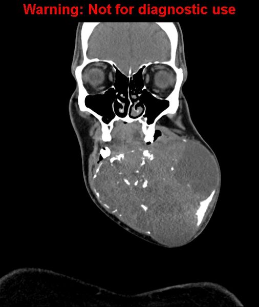 File:Ameloblastoma (Radiopaedia 33126-34164 D 21).jpg