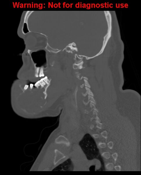 File:Ameloblastoma (Radiopaedia 33126-34164 Sagittal bone window 49).jpg