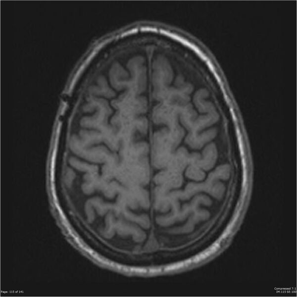 File:Anaplastic meningioma with recurrence (Radiopaedia 34452-35788 Axial T1 113).jpg