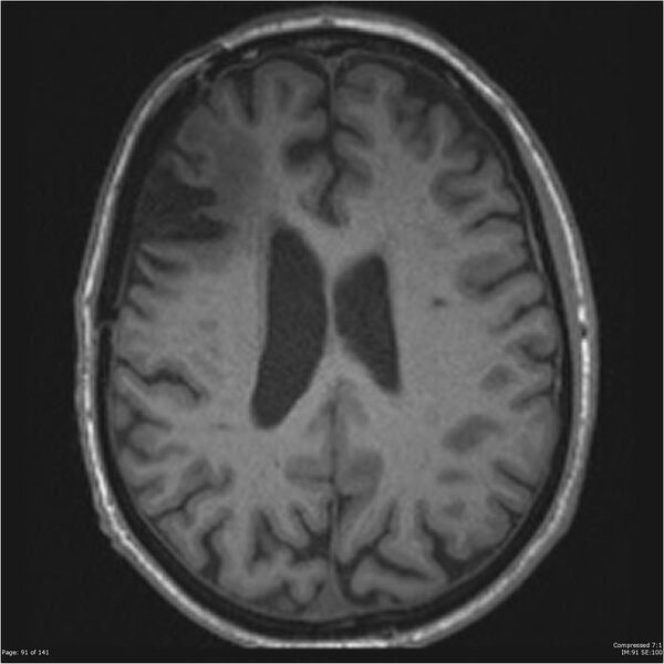 File:Anaplastic meningioma with recurrence (Radiopaedia 34452-35788 Axial T1 89).jpg