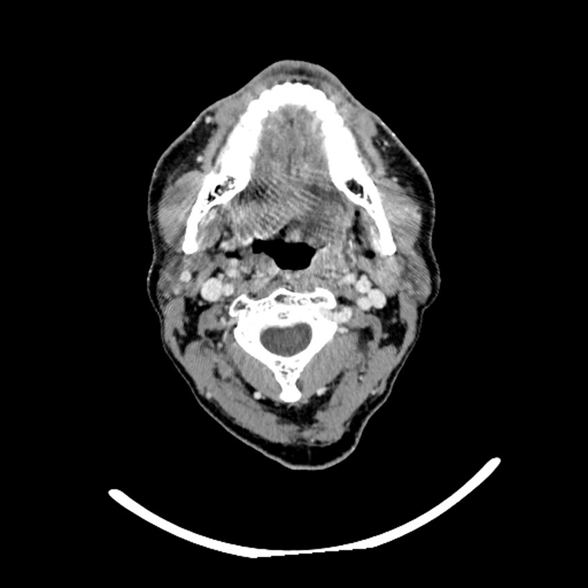 Anaplastic thyroid carcinoma (Radiopaedia 79087-92034 B 92).jpg
