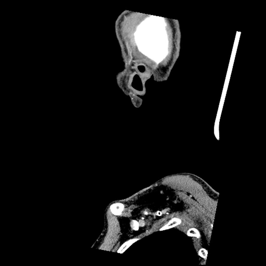 Anaplastic thyroid carcinoma (Radiopaedia 79087-92034 C 8).jpg