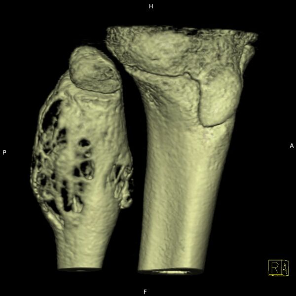 File:Aneurysmal bone cyst (ABC) (Radiopaedia 14333-14240 bone window 2).jpg