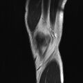 Anterior cruciate ligament full thickness tear (Radiopaedia 66268-75467 Sagittal T2 3).jpg
