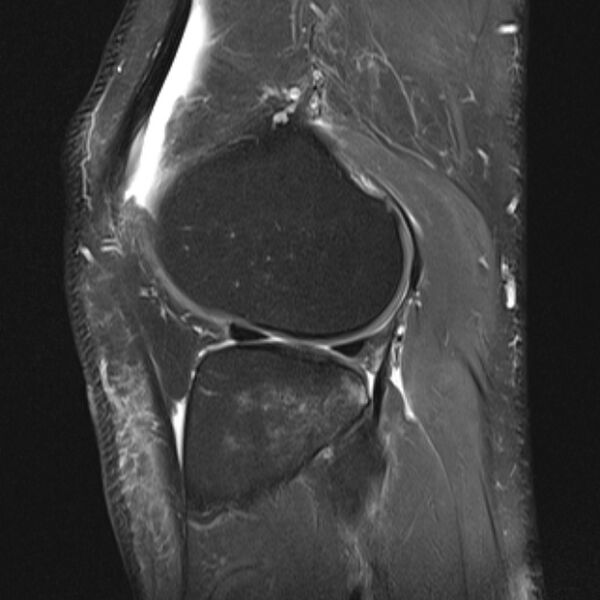 File:Anterior cruciate ligament tear - ramp lesion (Radiopaedia 71883-82322 Sagittal PD fat sat 7).jpg