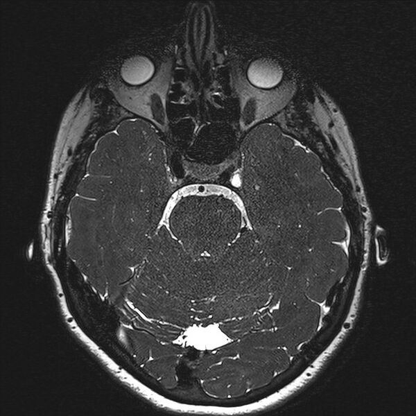 File:Anterior temporal encephalocele (Radiopaedia 82624-96808 Axial T2 high res 57).jpg