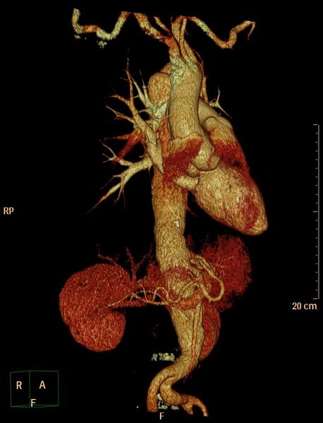 File:Aortic aneurysm and penetrating ulcer (Radiopaedia 23590-23704 3D reconstruction 4).jpg