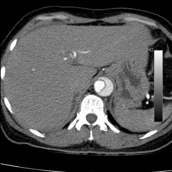 File:Aortic dissection - Stanford type A (Radiopaedia 29247-29659 A 70).jpg
