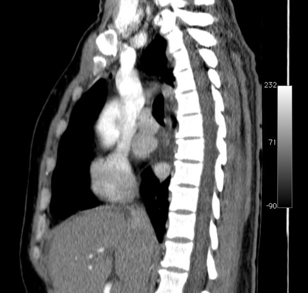 File:Aortic dissection - Stanford type A (Radiopaedia 29247-29659 C 34).jpg
