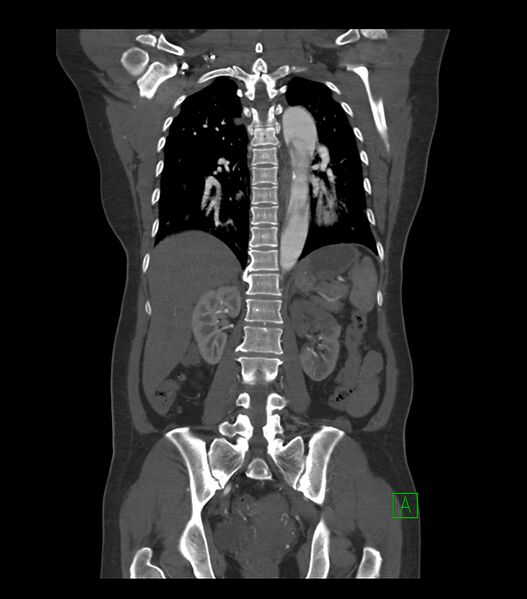 File:Aortic dissection with renal ischemia (Radiopaedia 76573-88338 C 24).jpg