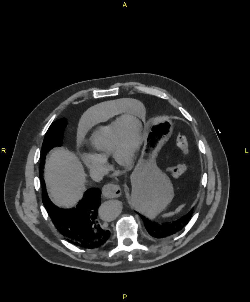 Aortic rupture (Radiopaedia 88822-105594 Axial non-contrast 177).jpg