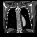 Aorto-coronary bypass graft aneurysms (Radiopaedia 40562-43157 B 36).png
