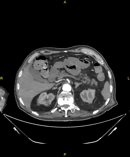 File:Aortoenteric fistula (Radiopaedia 84308-99603 B 83).jpg