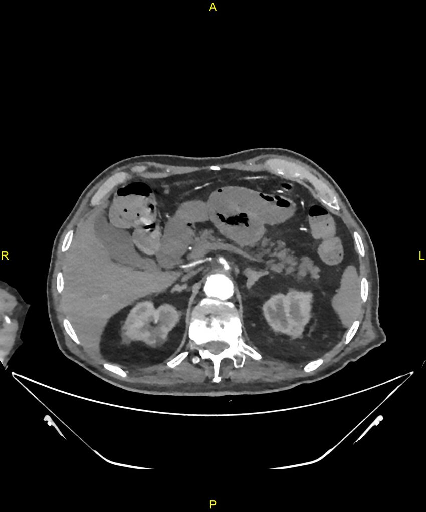 Aortoenteric fistula (Radiopaedia 84308-99603 B 83).jpg