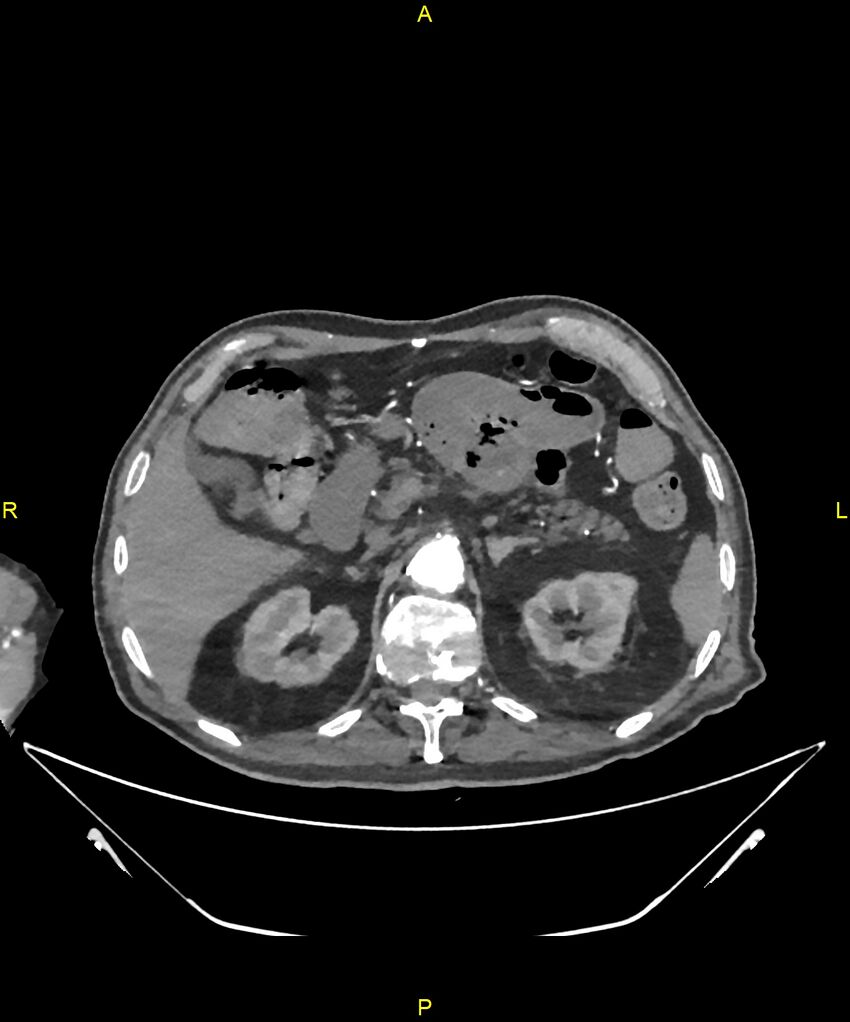 Aortoenteric fistula (Radiopaedia 84308-99603 B 89).jpg