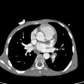 Aortopulmonary window, interrupted aortic arch and large PDA giving the descending aorta (Radiopaedia 35573-37074 B 44).jpg