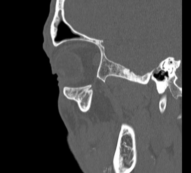 File:Aplastic maxillary sinuses (Radiopaedia 60030-67561 Sagittal bone window 27).jpg