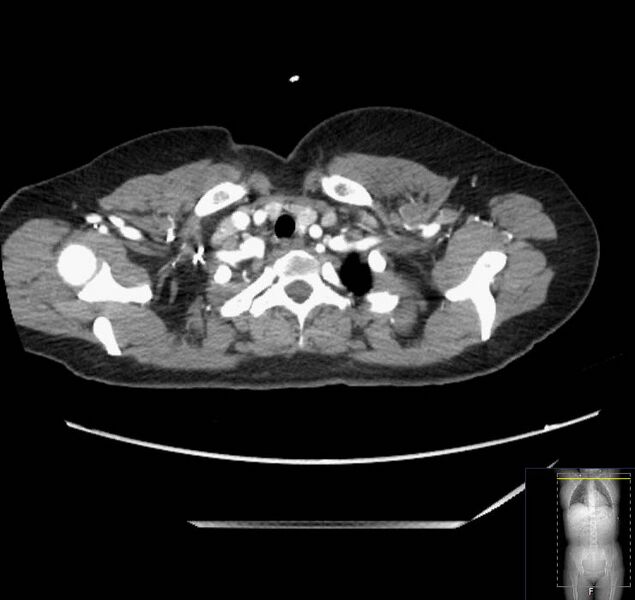 File:Appendicitis (CT angiogram) (Radiopaedia 154713-127660 Axial 237).jpg