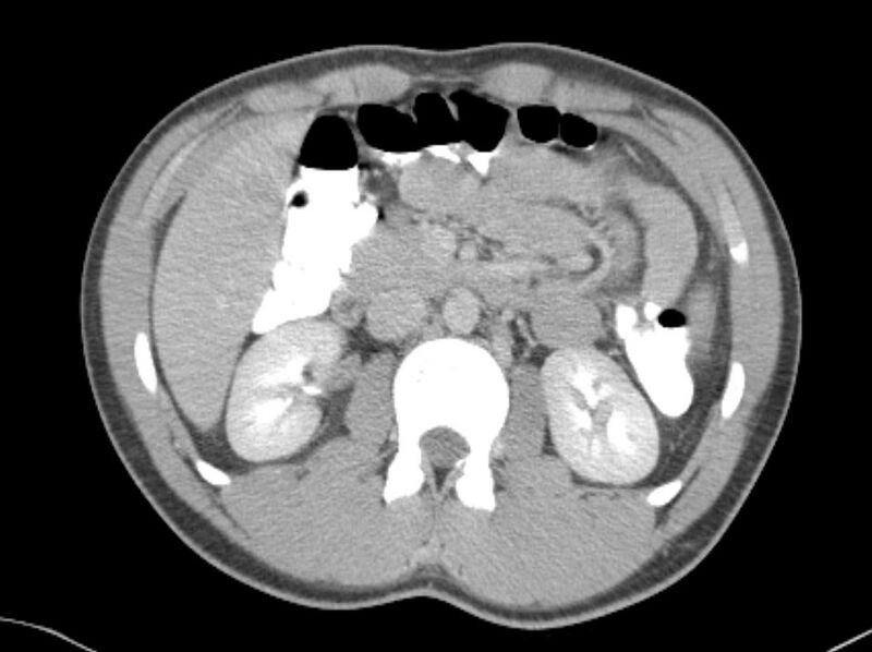 File:Appendicitis and incidental foregut duplication cyst (Radiopaedia 52962-58916 A 19).jpg