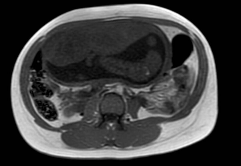 File:Appendicitis in gravida (MRI) (Radiopaedia 89433-106395 Axial T1 in-phase 33).jpg