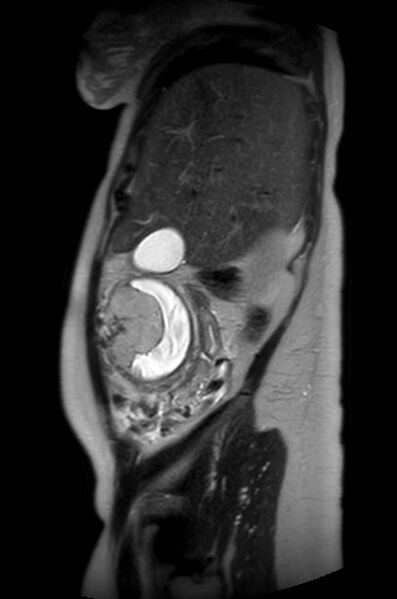 File:Appendicitis in gravida (MRI) (Radiopaedia 89433-106395 Sagittal T2 52).jpg