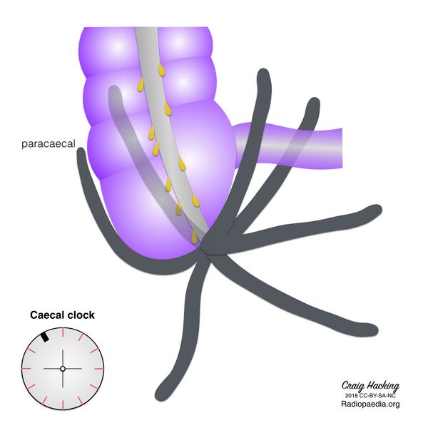 File:Appendix position (diagram) (Radiopaedia 62911-71293 D 7).jpeg