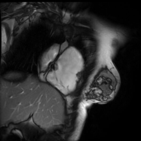 File:Arrhythmogenic right ventricular cardiomyopathy (Radiopaedia 87505-103850 2ch (RV) Cine SSFP 56).jpg