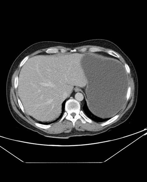 File:Arterial occlusive mesenteric ischemia (Radiopaedia 84641-100054 A 17).jpg