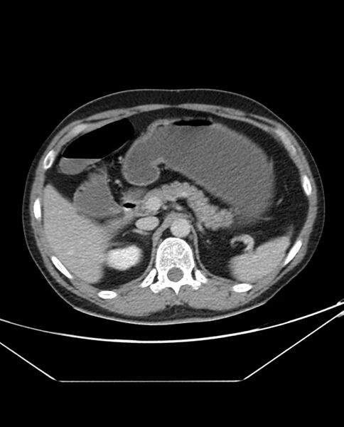 File:Arterial occlusive mesenteric ischemia (Radiopaedia 84641-100054 A 36).jpg