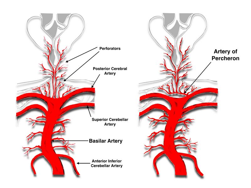File:Artery of Percheron infarction (Radiopaedia 28679-28964 Illustration 1).jpg
