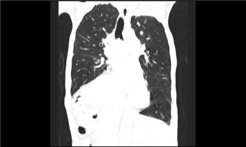 File:Aspergilloma (Radiopaedia 20788-20701 Coronal lung window 8).jpg