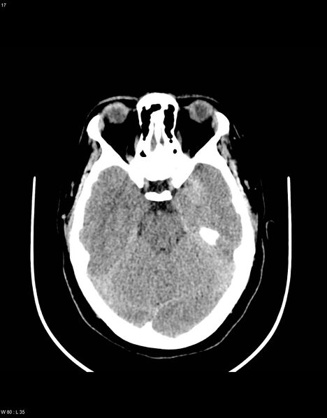 File:Astroblastoma (Radiopaedia 39792-42216 Axial non-contrast 16).jpg