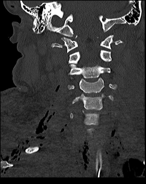 File:Atlanto-occipital dissociation - Traynelis type 1 (Radiopaedia 87570-103948 Coronal bone window 31).jpg