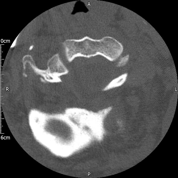 File:Atlas fracture with Currarino type A congenital defect (Radiopaedia 71747-82144 Axial bone window 44).jpg