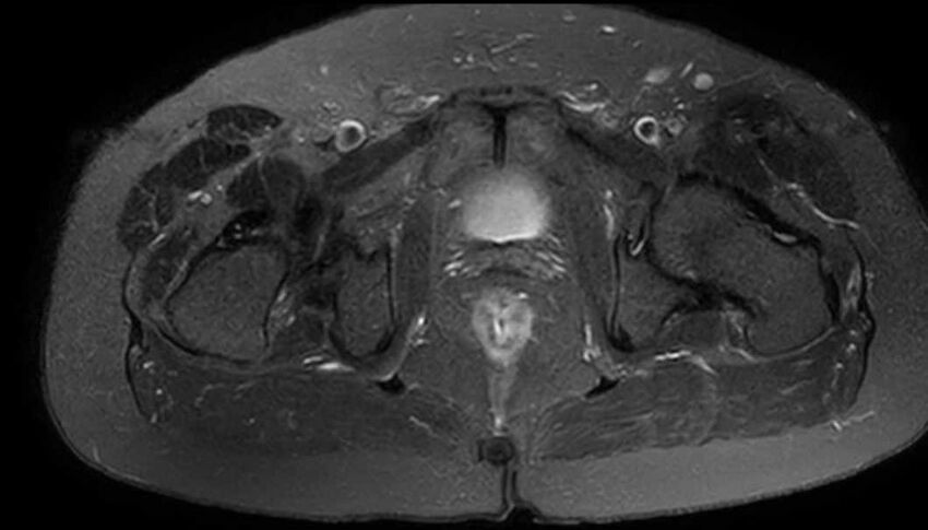 Atypical lipomatous tumor - thigh (Radiopaedia 68975-78734 Axial T2 fat sat 89).jpg