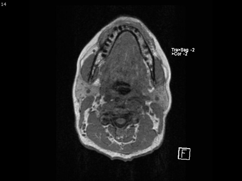 Atypical meningioma - intraosseous (Radiopaedia 64915-74572 Axial T1 14).jpg