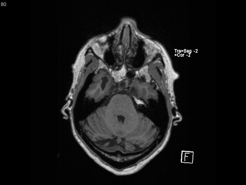 Atypical meningioma - intraosseous (Radiopaedia 64915-74572 Axial T1 80).jpg