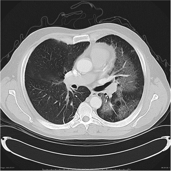 File:Atypical pneumonia - Q fever (Radiopaedia 21993-21989 lung window 21).jpg