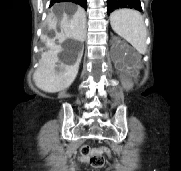 File:Autosomal dominant polycystic kidney disease (Radiopaedia 16777-16490 B 37).jpg