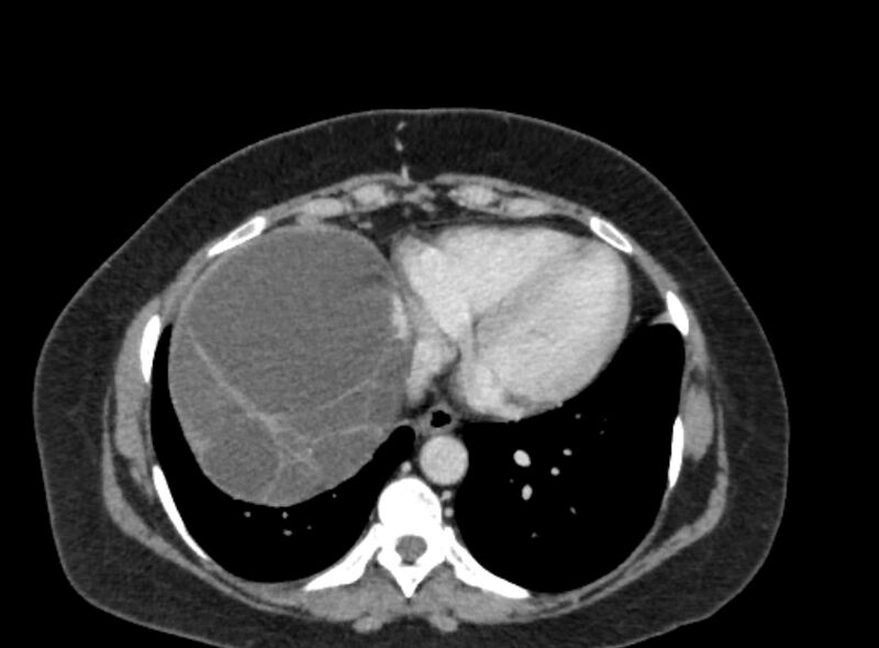 File:Autosomal dominant polycystic kidney disease (Radiopaedia 57124-64017 A 15).jpg