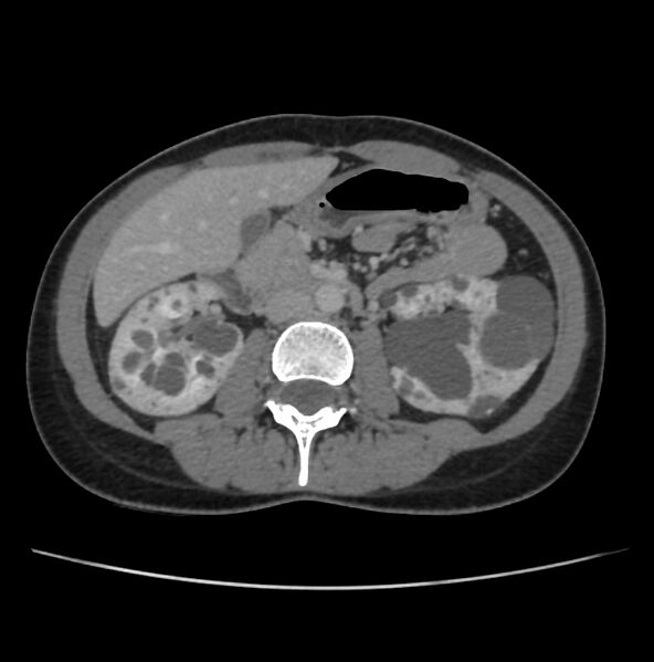 File:Autosomal dominant polycystic kidney disease - early onset (Radiopaedia 40734-43387 A 36).jpg