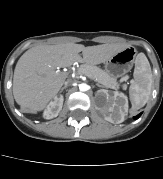 File:Autosomal dominant polycystic kidney disease - early onset (Radiopaedia 40734-43387 B 9).jpg