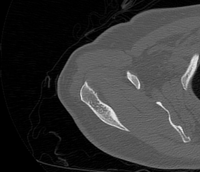 File:Avulsion fracture - greater tuberosity of humerus (Radiopaedia 71216-81514 Axial bone window 18).jpg