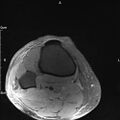 Avulsion fracture of the fibular head (Radiopaedia 74804-85808 Axial PD fat sat 36).jpg