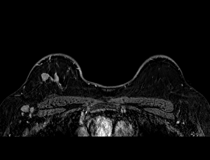 Axillary lymph nodes - surgical levels (Radiopaedia 84413-104719 Axial T1 C+ fat sat 18).jpg