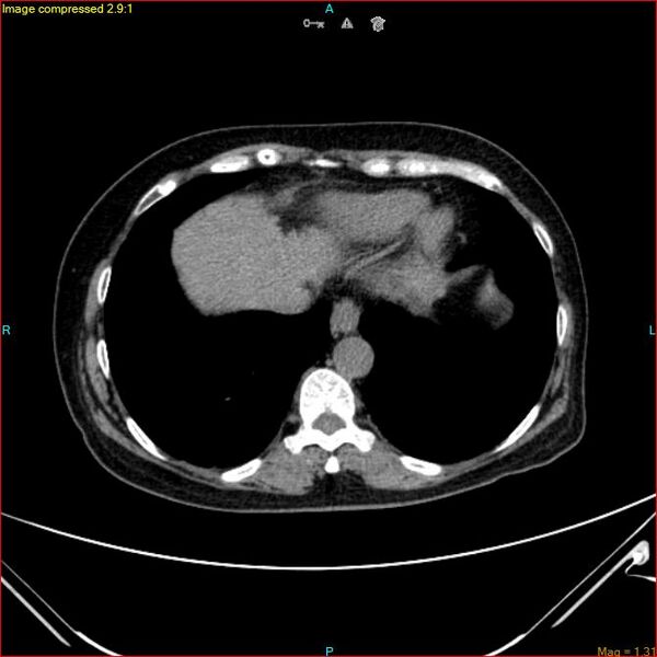 File:Azygos vein aneurysm (Radiopaedia 77824-90130 A 44).jpg