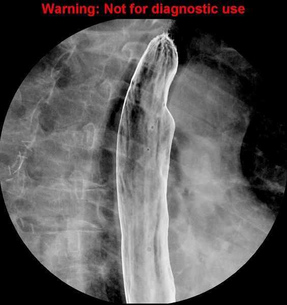 File:Barrett esophagus (Radiopaedia 44421-48075 A 7).jpg