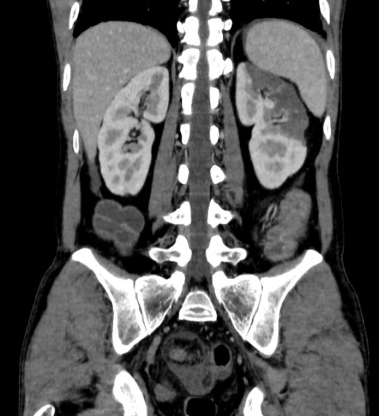 File:Behçet's disease- abdominal vasculitis (Radiopaedia 55955-62570 B 45).jpg