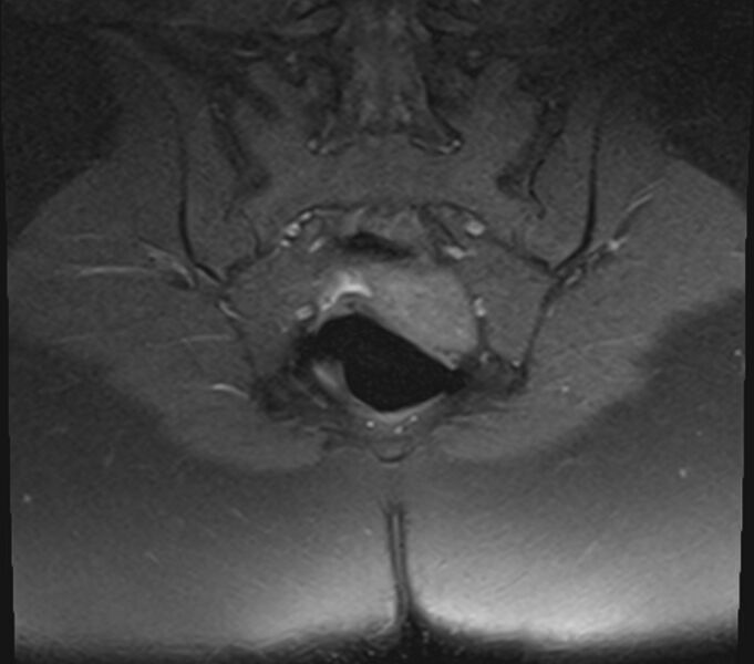 File:Bicornuate uterus (Radiopaedia 71214-81511 Coronal T1 fat sat 4).jpg